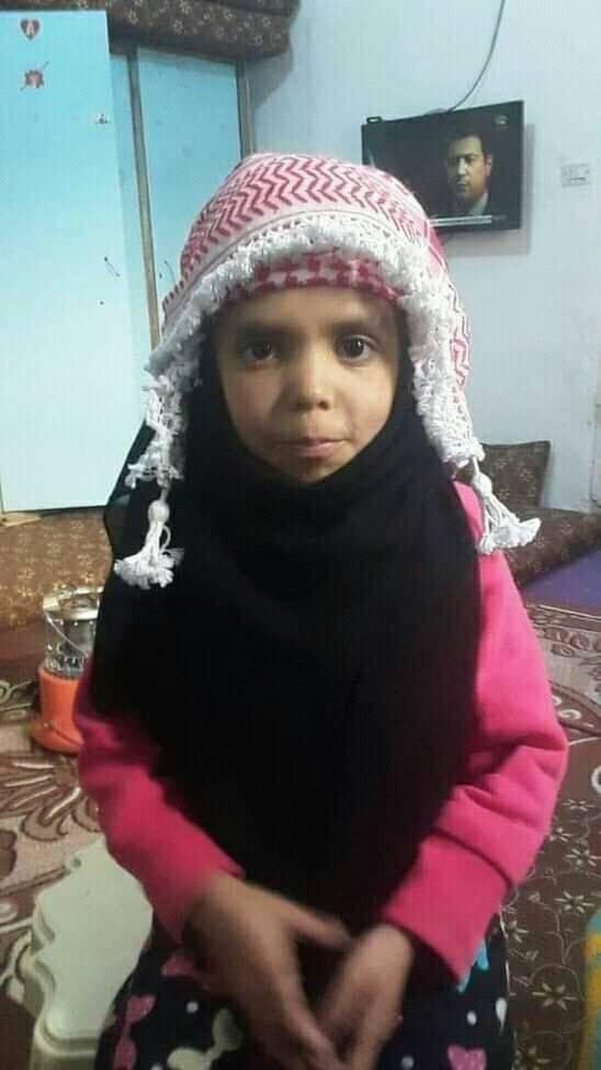 التبرع بقرنيتي الطفلة جوري