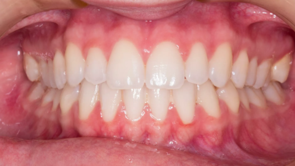 ضرس العقل أسباب تأخر ظهوره في الفم