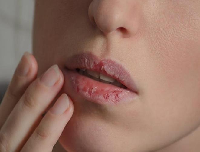كيفية الوقاية من جفاف الشفاه للحامل