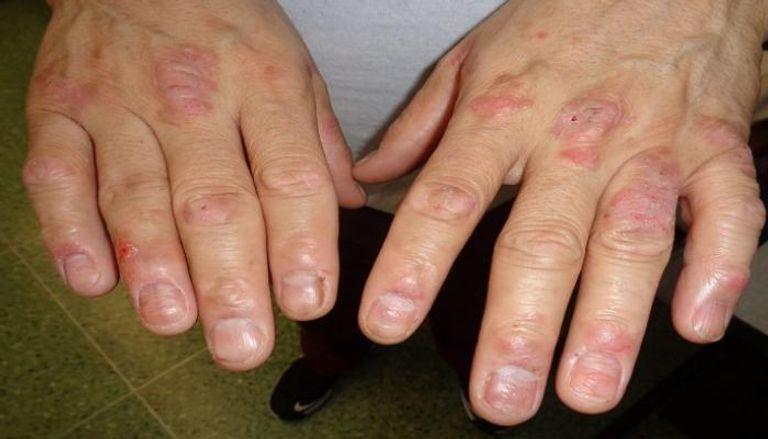 التهاب المفاصل الصدفي اليكم الأعراض الصعبة 