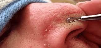 3 وصفات منزلية مضمونة للتخلص من الرؤوس السوداء