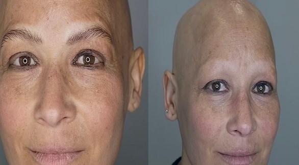  تفقد شعرها بالكامل بسبب حالة نادرة