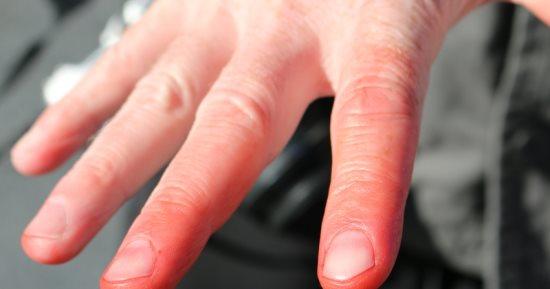 تعرف إلى أسباب وطرق علاج قضمة الصقيع