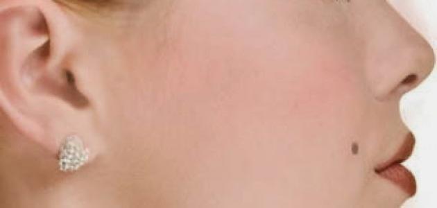 ما هو حب الخال وما أسباب ظهوره في البشرة