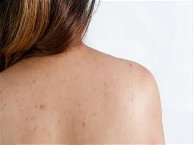 إزالة حبوب الظهر نهائيًا بـ4 علاجات من مطبخك