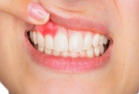 هكذا تعرف أنه لديك إلتهاب اللثة