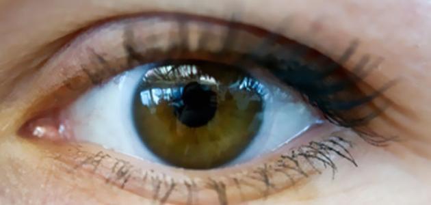 25 مريضا بمأدبا بحاجة لقرنيات