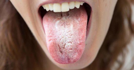 القلاع طرق مذهلة تمنع ظهوره في الفم