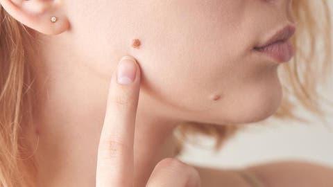 خطوات العناية بالبشرة بعد ازالة العلامات الخلقية أو الشامة