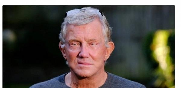 بسبب جراحة فاشلة رجل لا يستطيع أن يرمش أو يغلق عينيه