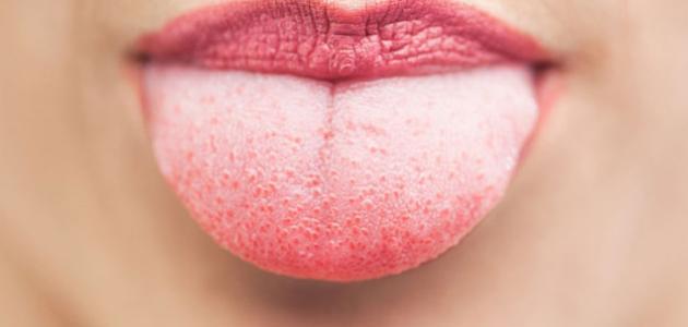 علاجات منزلية للتخلص من اللسان الأبيض