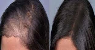 أقوى خلطة طبيعية لتكثيف غرة الشعر وعلاج التساقط