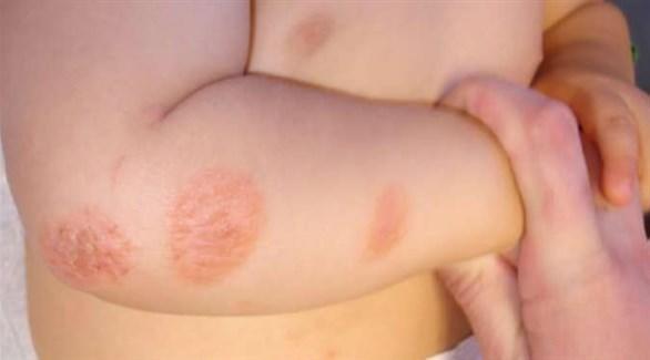  طفل مصاب بالتهاب الجلد العصبي هذه الملابس تناسبه 