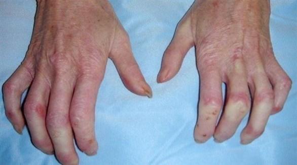  تصلب الجلد يهدد بأمراض خطيرة