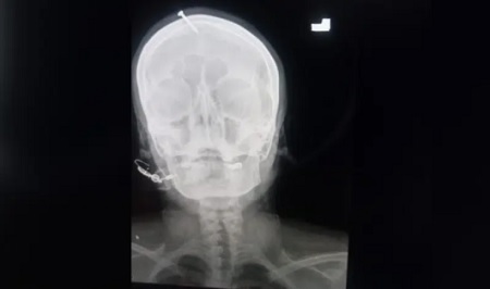 باكستان: مشعوذ يدق مسماراً في رأس امرأة - صورة 