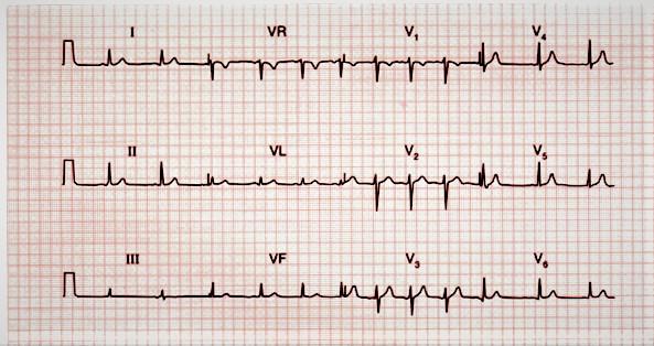 لسلامة القلبنصيحة لمن أصيبوا بكورونا  فيديو 