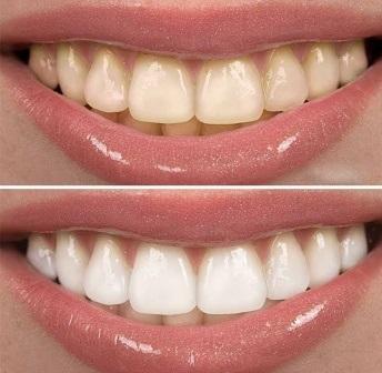 وصفة لتبييض الأسنان من الصفار