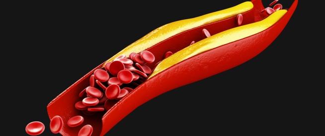 4 حميات تعالج ارتفاع الكوليسترول