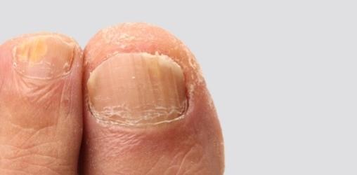 أسباب تصلب الظفر