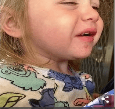  طفلة تعاني من التهابات شديدة حول فمها بسبب قبلة