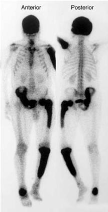 ما هو مرض باجيت ومن هم الأكثر عرضة للإصابة به