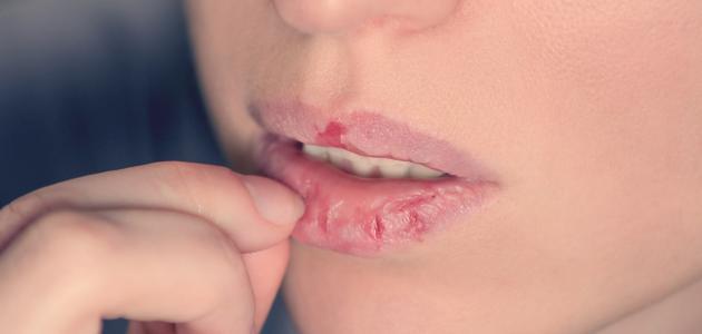 ما تجهلونه عن تشقّق زوايا الفم
