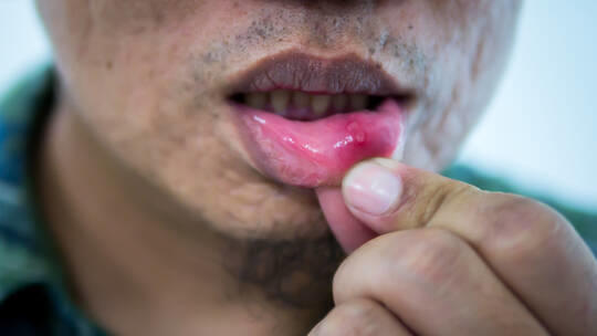 طرق منزلية بسيطة لتسريع التئام تقرحات الفم