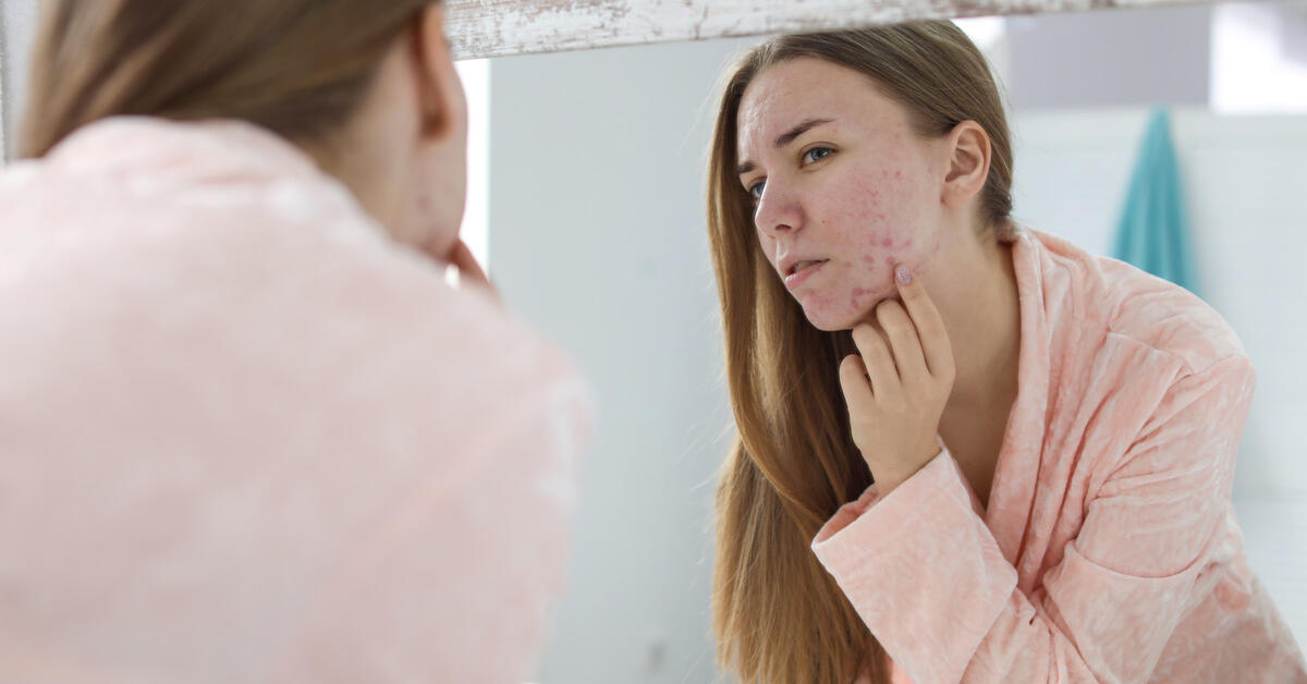 فوائد صابون الغار للتخلص من حب الشباب