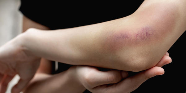 تعرف على أسباب ظهور الكدمات في الجسم