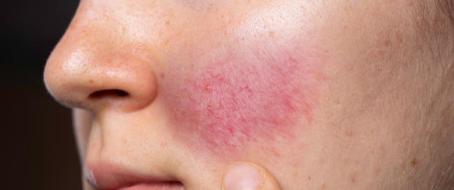 وصفات طبيعية لعلاج إحمرار البشرة بعد إزالة الشعر