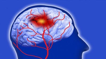 الطعام الأفضل لتقليل خطر السكتة الدماغية 