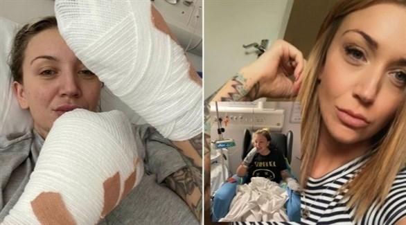  تخضع لبتر جميع أصابع يديها جراء عدوى في الكلى