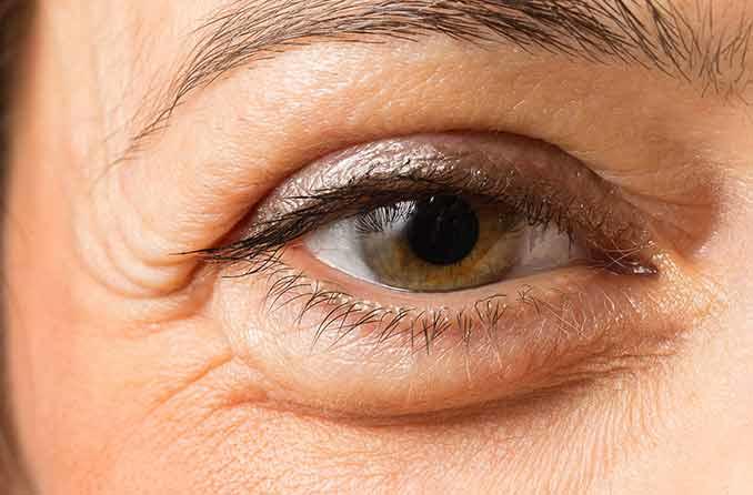 7 نصائح للتخلص من انتفاخ العين