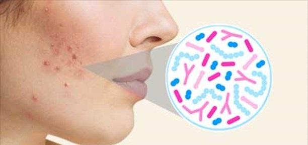 مترجم أردني بكتيريا الأمعاء لعلاج حب الشباب