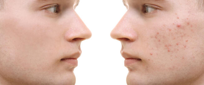 اكتشاف يغير طريقة علاج حب الشباب