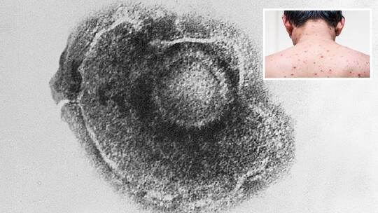 تحذيرات من مرض خطير جدا ينتشر أسرع من كورونا
