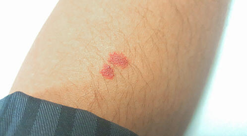 علاج حبوب الجسم بـ 3 وصفات طبيعية