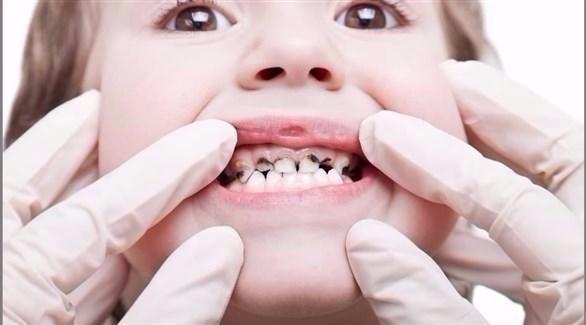 5 طرق بسيطة للوقاية من تسوس الأسنان للأطفال