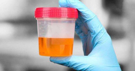 لا تتجاهلها الأسباب المحتملة للون البول الغامق