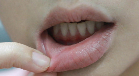 تقرحات الفم أسبابها والطرق العلاجية المنزلية