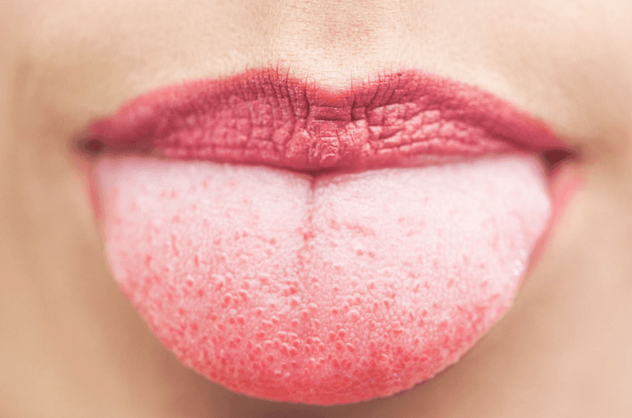 4 نصائح فعالة للتخلص من حروق اللسان بدقائق