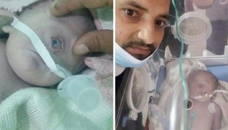 ولادة طفل بعين واحدة في اليمن  صورة 