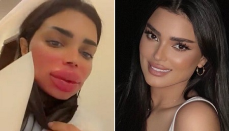 شاهد الإعلامية أودي الزبن تتعرض لحساسية بسبب إبرة تذويب