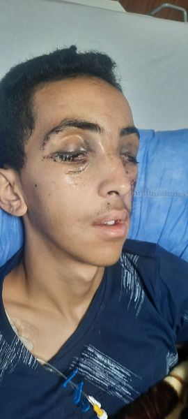 عمليه نوعية لشاب بعد دخول مرآة باص برأسه 