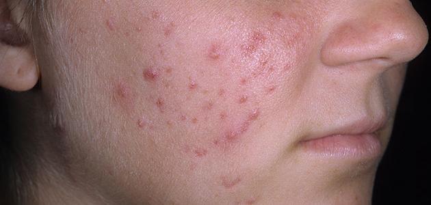 اليكم الأسباب المباشرة لظهور حب الشباب