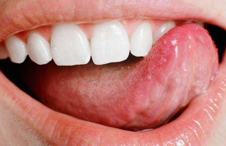 أبرز أسباب حبوب اللسان وهل تحتاج إلى طبيب