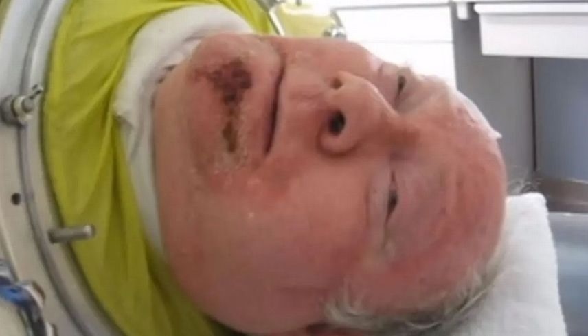 يعيش 70 عاماً داخل جهاز الرئة الحديدية بعدما أصيب بالشلل