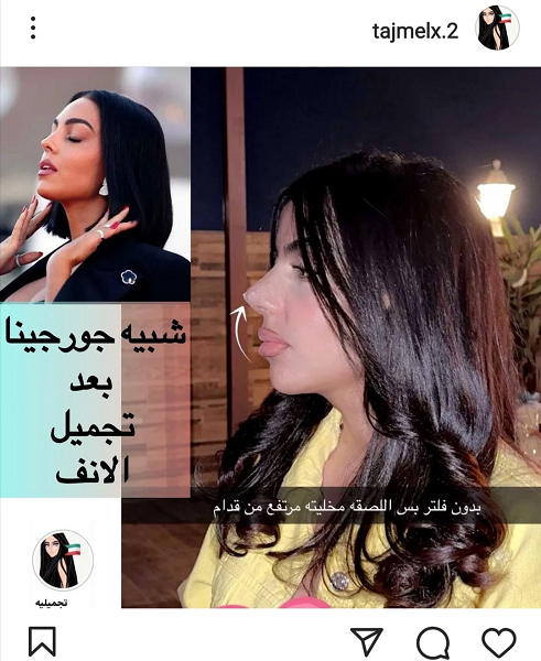 شبيهة جورجينا ريما العنزي تفاجئ متابعيها بعملية تجميل جديدة