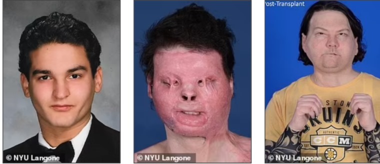 صاحب اول عملية زرع وجه في العالم يحتفل بخطوبته
