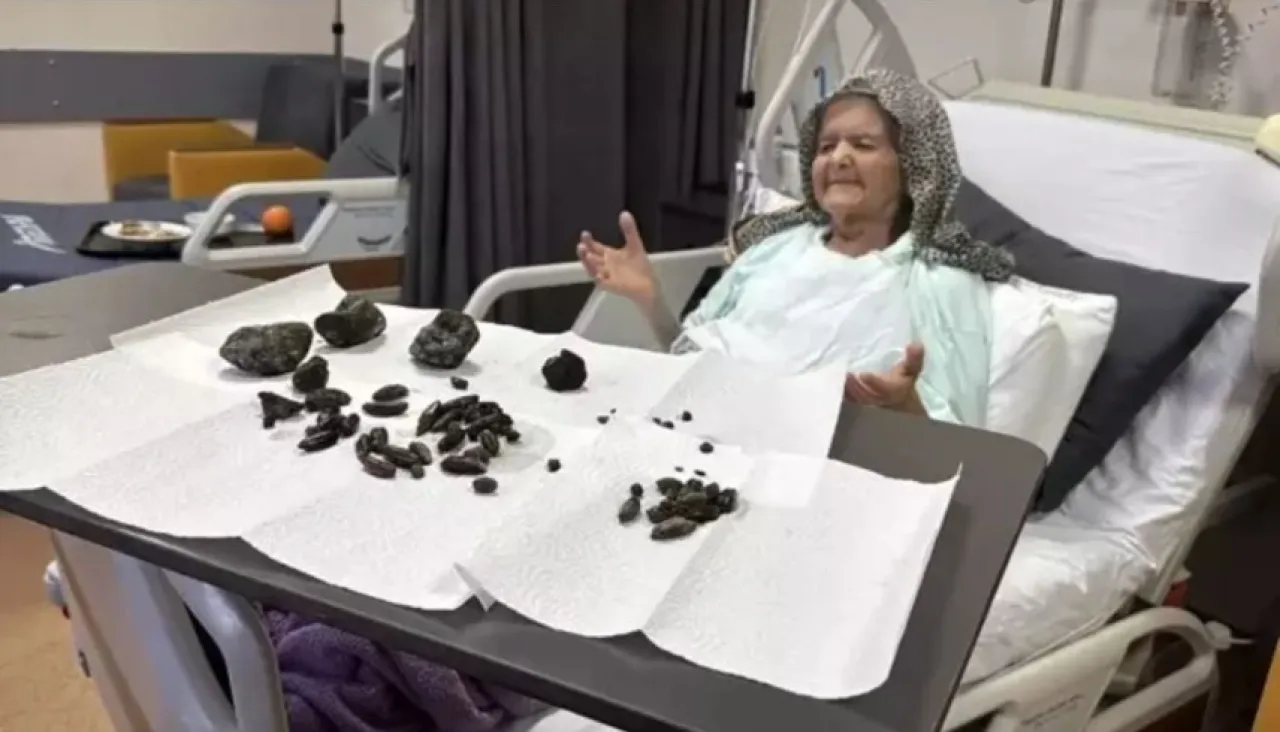 تركيا أطباء يعثرون على أجسام غريبة في معدة مسنّة